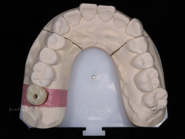 Implant_zirconia01